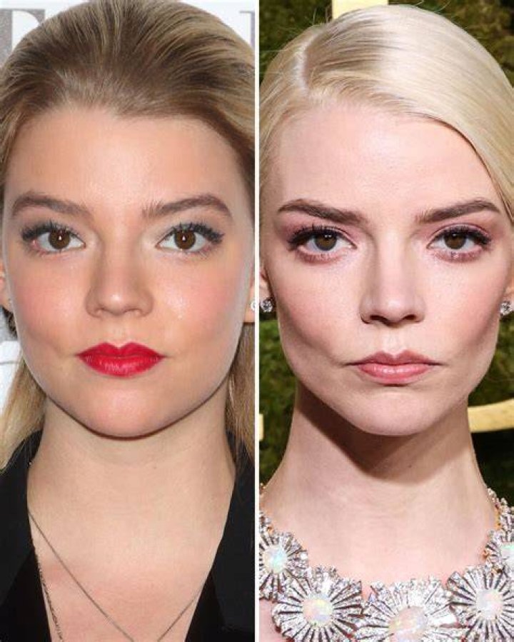 Anya TaylorJoy Before Plastic Surgery Botox, Nose Job, Lips, and