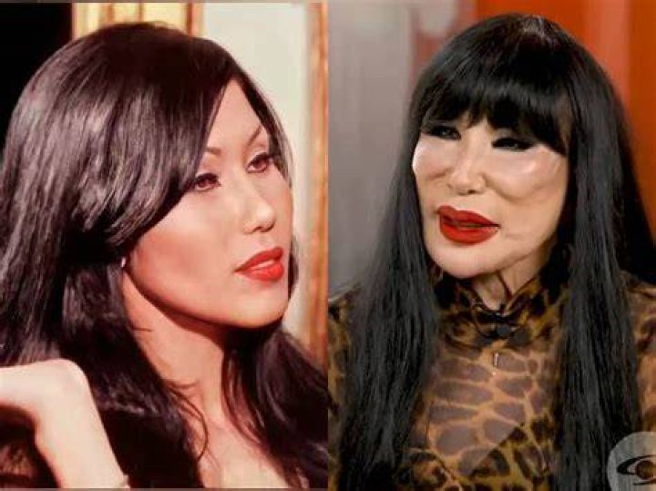 Lyn May Plastic Surgery Let&rsquo;s Reveal All about It!
