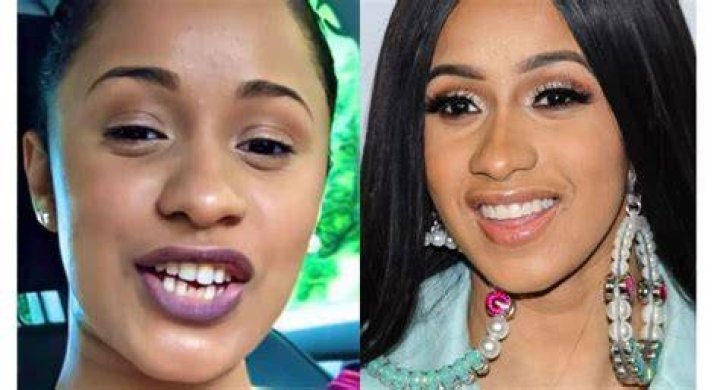 Unveiling Cardi B's Teeth Transformation: Before And After